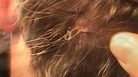 Zit Pop On Scalp Zoomed In Slowmotion Youtube