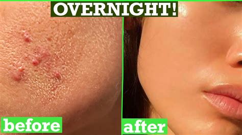 How To Get Rid Of Acne Pimples Tiny Bumps On Face Overnight Simple