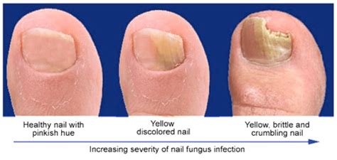 Types Of Nail Fungus Home Interior Design