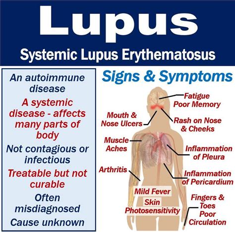 What Is Lupus Symptoms Causes Diagnosis And Treatment