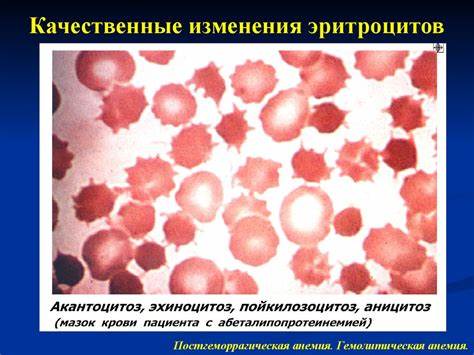 Анемия постгеморрагическая диета Патофизиология системы крови. Постгеморрагическая анемия Патофизиология системы крови. Постгеморрагическая анемия Анемия постгеморрагическая диета