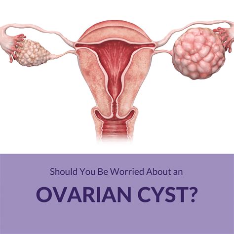 should you be worried about an ovarian cyst sunshine state women s care llc