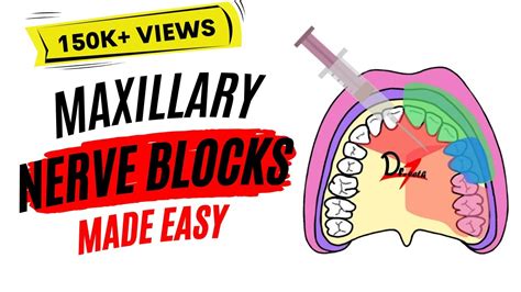 Maxillary Nerve Block Anesthesia For Dental Procedures Youtube