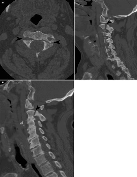 Imaging Of Spinal Trauma Radiology Key