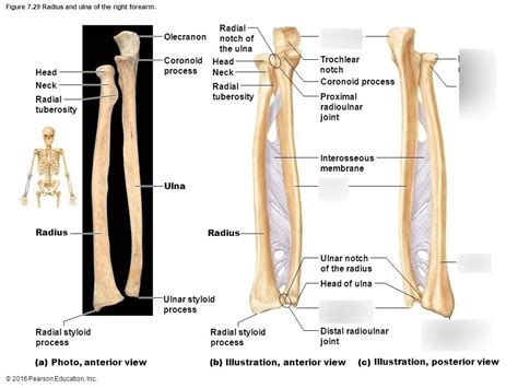 Preoperative Planning Of The Radius And Ulna The Mirrored