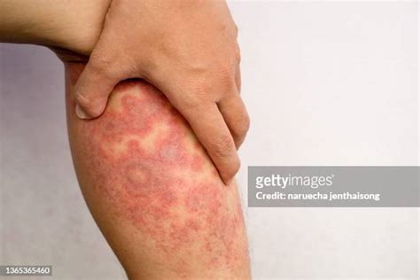 Atopic Dermatitis Leg Photos And Premium High Res Pictures Getty Images