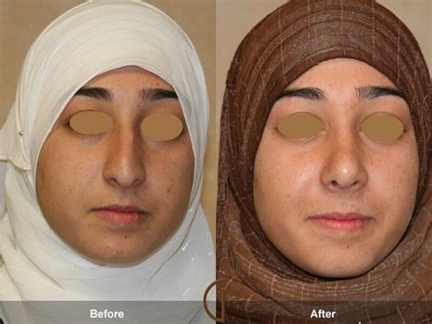 Ethnic Rhinoplasty Newport Beach Facial Plastic Surgery Dr Sadati