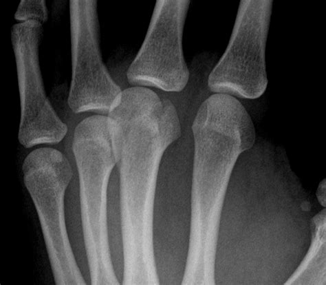 3rd metacarpal fracture | Image | Radiopaedia.org