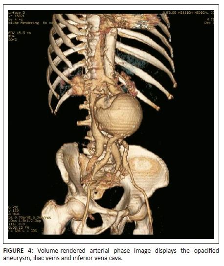 Computed Tomographic Diagnosis Of Aortocaval Fistula