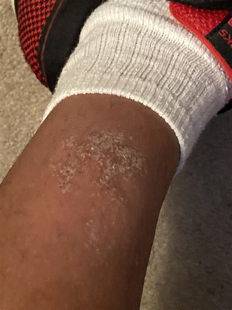 Is This Eczema It Is Only On This Spot On My Leg Been Using