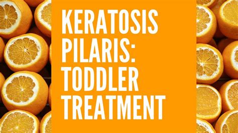 Keratosis Pilaris Toddler Treatment Youtube