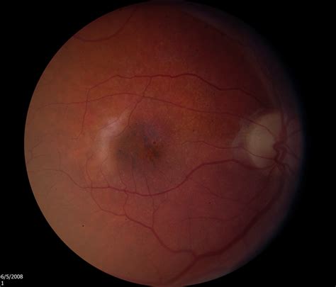 Macular Degeneration With Large Submacular Hemorrhage Retina Image Bank
