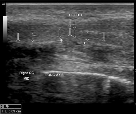 Penile fracture | Image | Radiopaedia.org