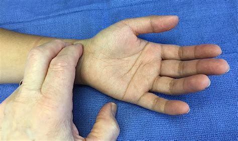 Radial Pulse Hand Surgery Resource