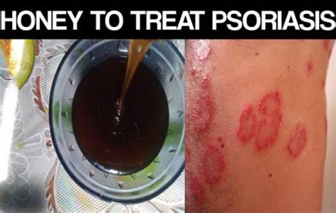 How To Use Honey For Psoriasis 12 Methods Included Skin Disease