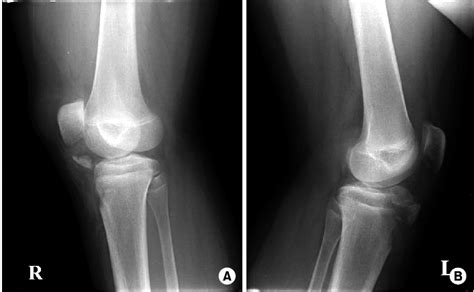 A Rt Avulsion Fracture Of The Tibial Tuberosity With Infrapatellar