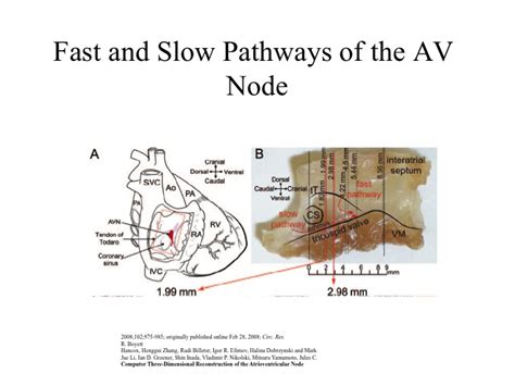 Fast And Slow Pathways Of The Av Node Heart Rhythm Center