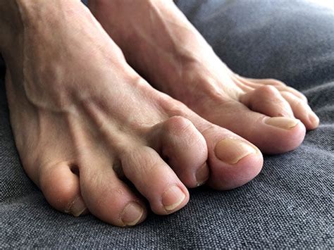 What Are Hammer Toes And What Causes Them Protalus