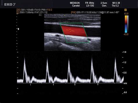 Doppler Ultrasound Of The Carotid Arteries Cardiac