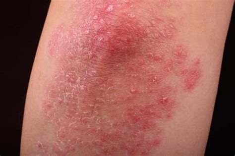 Are Psoriasis And Acne Related Types Of Acne And Psoriasis