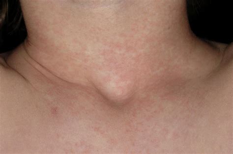 Scarlet Fever Rash Photograph By Dr P Marazziscience Photo Library