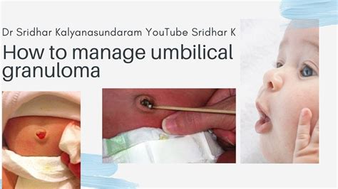 What Is An Umbilical Granuloma How Do We Manage The Umbilical
