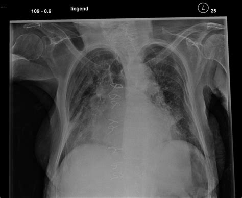 Left Atrial Enlargement Chest X Ray Wikidoc
