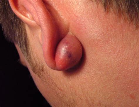 The Best 17 Sebaceous Cyst Behind Ear Treatment Artbeamall