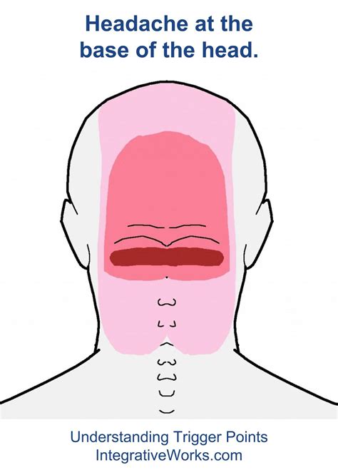 Understanding Trigger Points Headache At The Back Of Your Head In