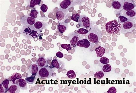 Acute Myelogenous Leukemia China Pdf Ppt Case Reports Symptoms