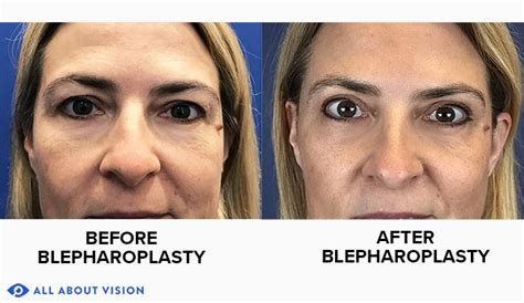 blepharoplasty eyelid surgery and eye lifts
