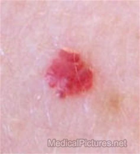 Cherry angiomas are benign growths made up of blood vessels, which give them their characteristic red color. Cherry Angiomas Pictures