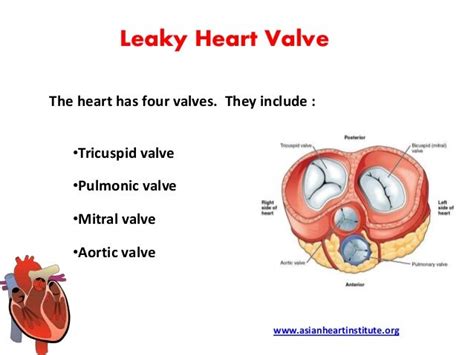Asian Heart Institute Leaky Heart Valve Symptoms