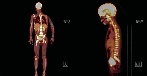 Integrated Whole Body Petct Scan Using 18 F Fdg Anteroposterior And