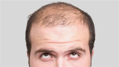 Alopecia Androgenetica Come e cosa si può fare Fan s Parrucchieri