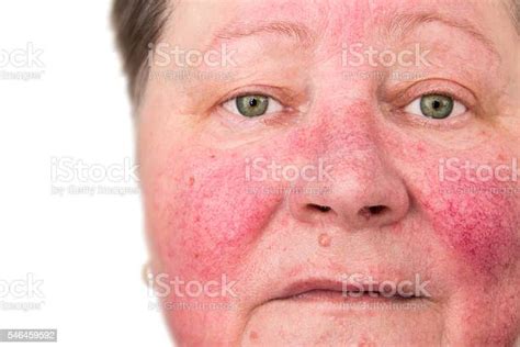 Elderly Woman With Rosacea Facial Skin Disorder Stock Photo Download