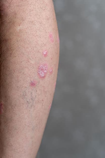 Premium Photo Psoriasis Vulgaris Skin Patches Are Typically Red Itchy