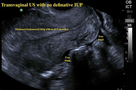 Malignant growths may spread to the pouch of douglas, and women can experience discomfort if the pouch of douglas fills with fluid, pus, and. Early Pregnancy Ultrasound - docnesia.com