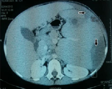 Abdominal Ct Scan Showing The Liver And Spleen Enlargement
