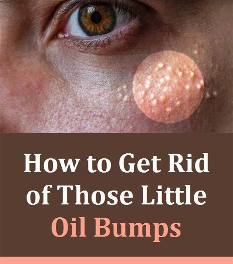 How To Get Rid Of Those Little Oil Bumps On The Face White Pimples On