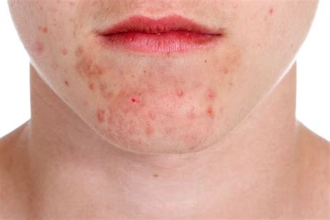 Skin Disorder Acne Eczema Dermatitis Acupuncture Hingorani