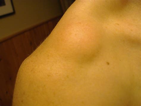 9 Possible Causes Of Hard Lumps On Your Collarbone Tsmp Medical Blog Tsmp Medical Blog