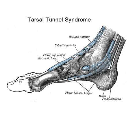 Tarsal Tunnel Syndrome