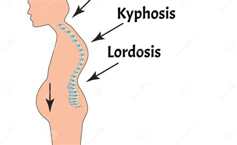 Curvatures Of The Spine Lordosis Kyphosis Scoliosis Otosection