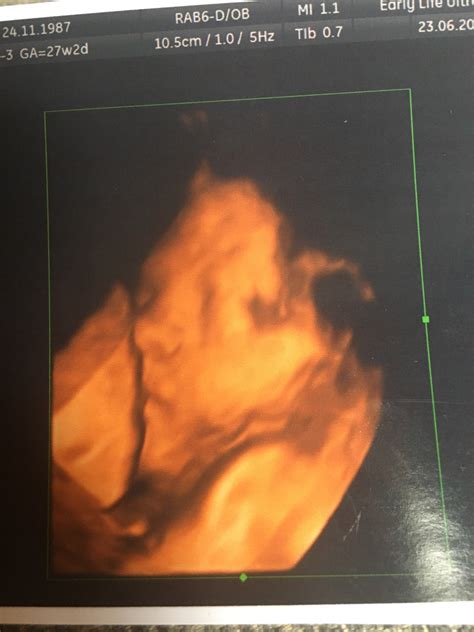 4d Scan With An Anterior Placenta And Breech Baby Netmums Chat