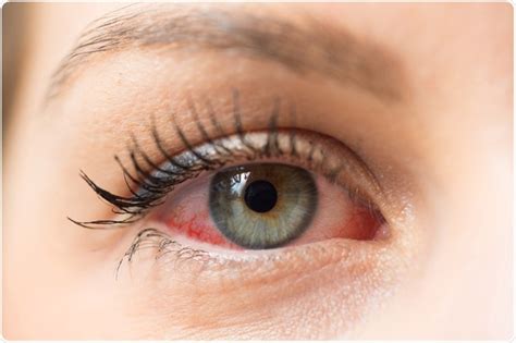 Types Of Eye Allergy