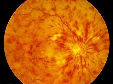 Retinal Vein Occlusion Eye Health Central