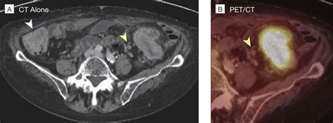 T3 stage tumor with less than 5 mm extension beyond the muscularis propria. Diagnostic Accuracy of Colorectal Cancer Staging With ...