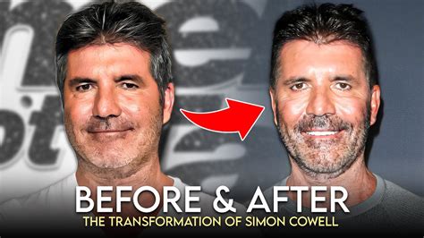 Simon Cowell Before And After What Happened To His Face Youtube