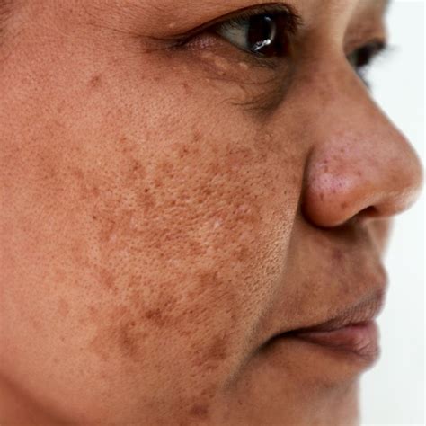 Know All About Uneven Skin Tone And Pigmentation